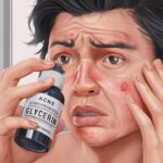 Is glycerin good for acne? Exploring Its Role in Acne Treatment